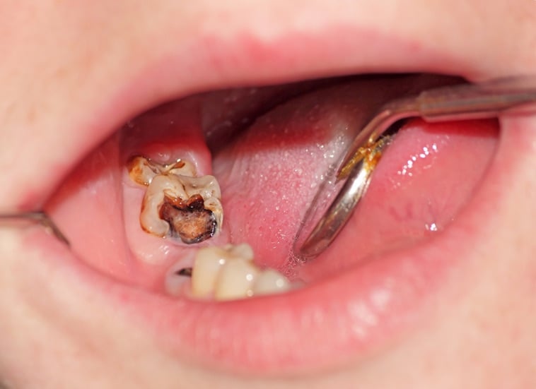 Tooth decay is a significant and expensive health problem. From www.shutterstock.com 